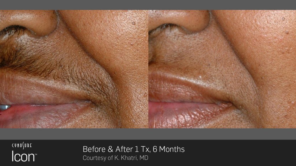 Before and after hair removal results