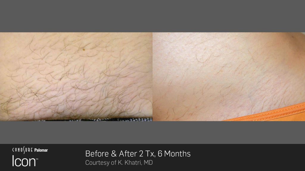 Before and after results