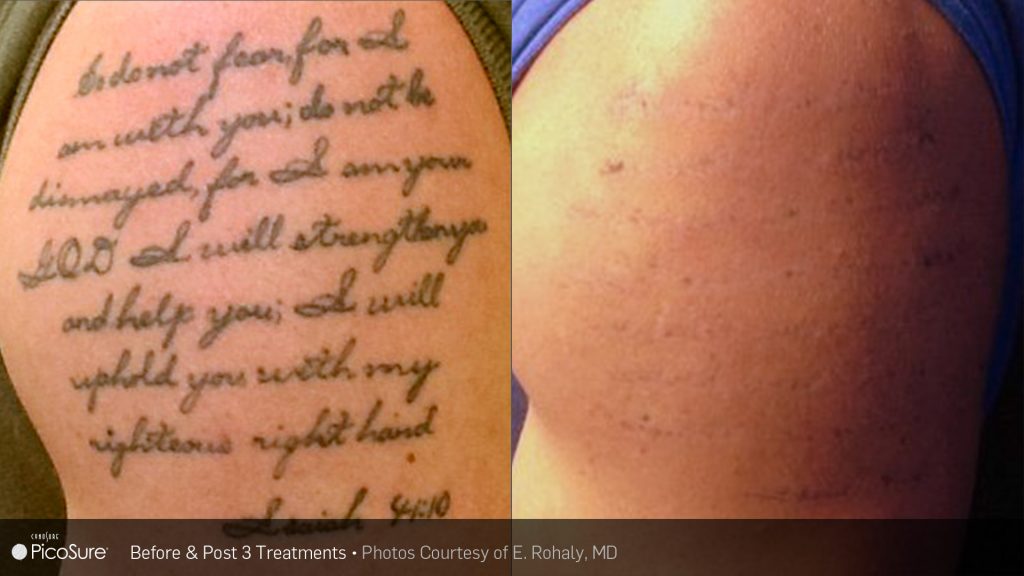 Before and after laser tattoo removal