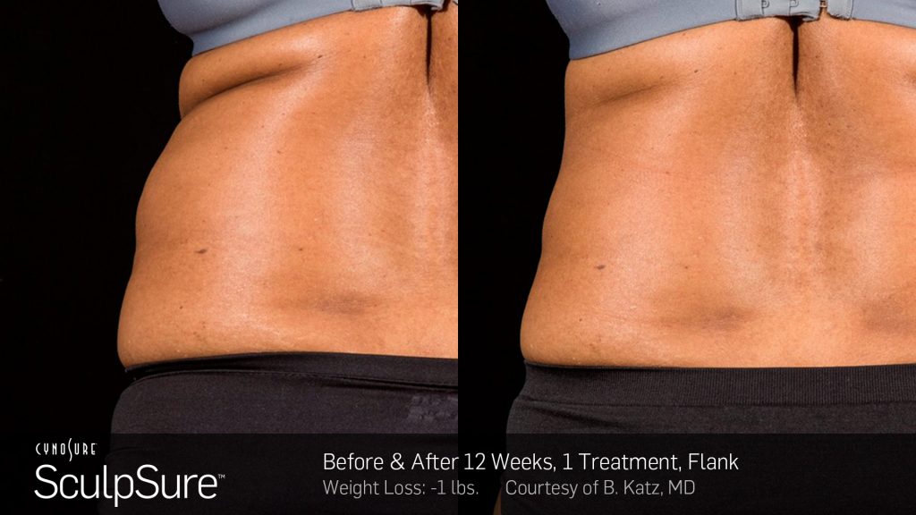 Before and after SculpSure results