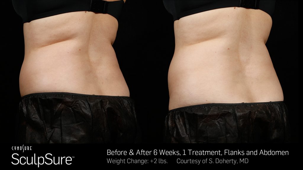 Before and after SculpSure results for back