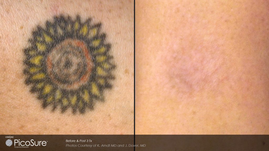 Before and after laser tattoo removal