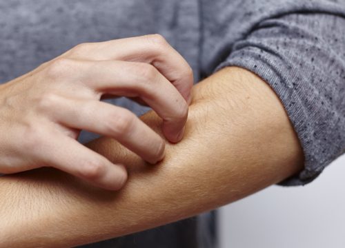 Man with food allergies scratching his arm