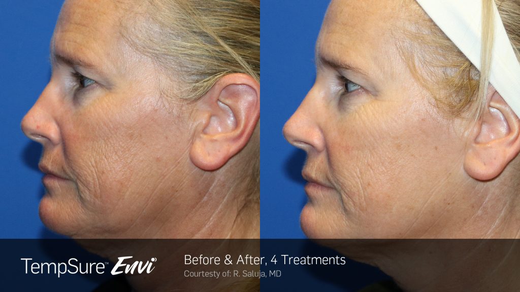 Before and after TempSure Envi results