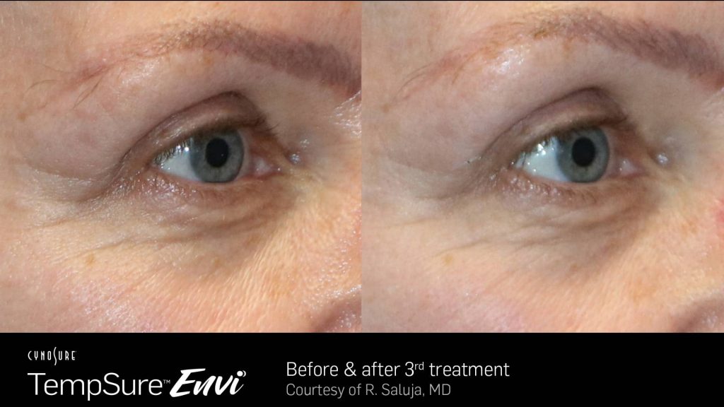 Before and after TempSure Envi results