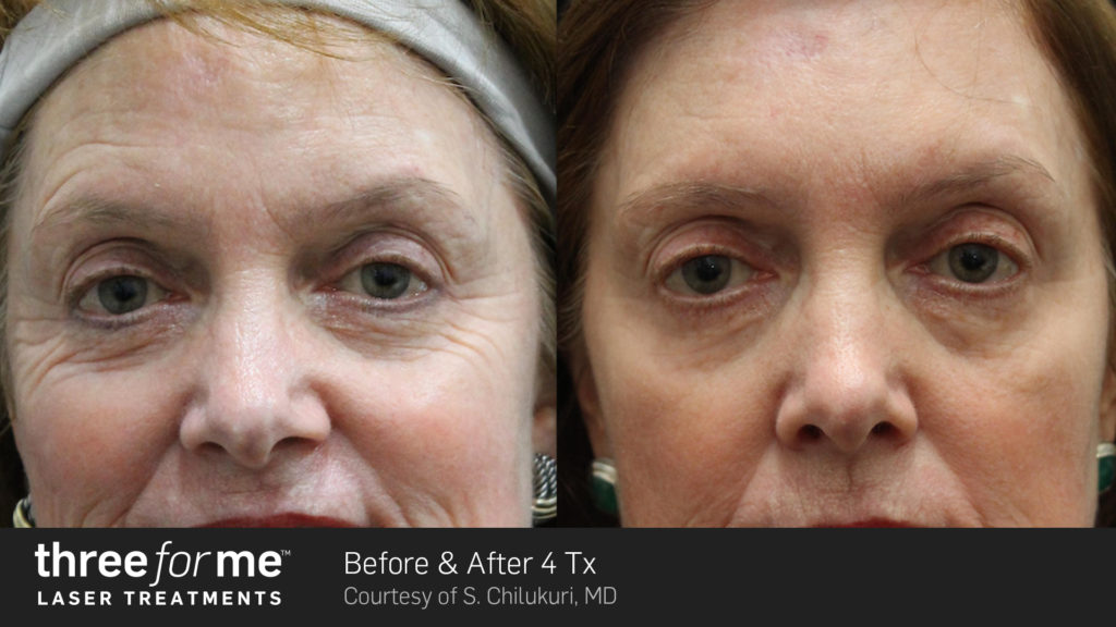 Before and after threeforme treatments