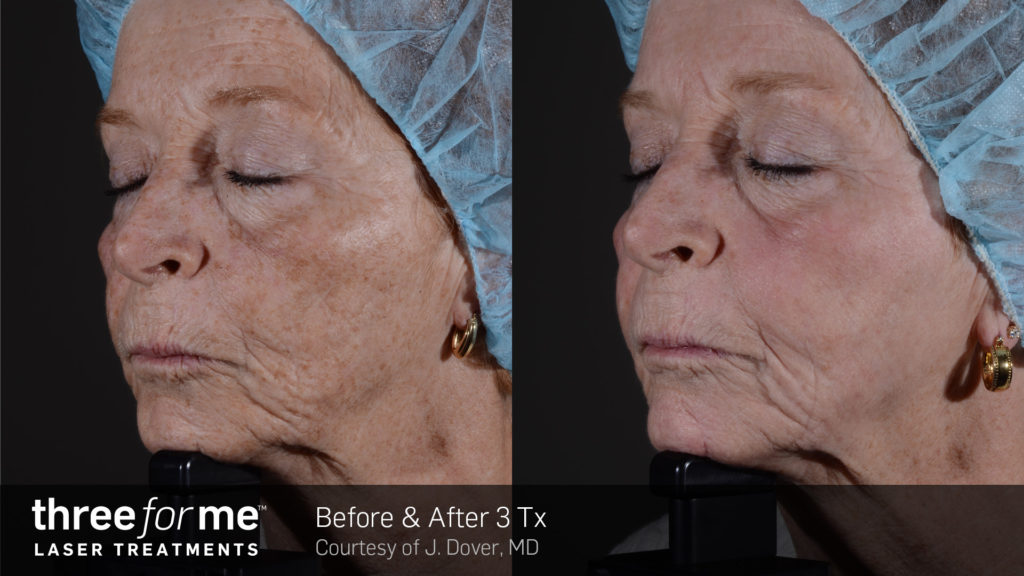 Before and after threeforme treatments