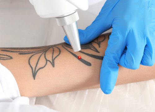 Treatment for unwanted tattoos