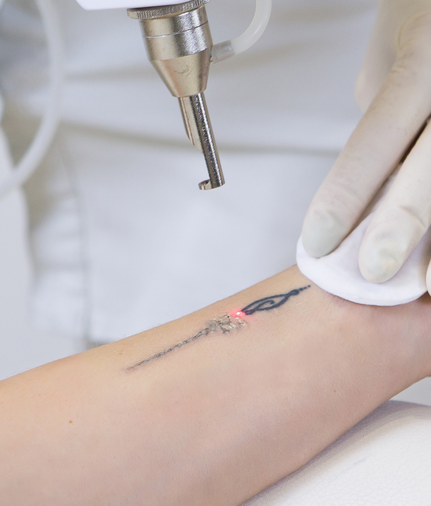 Laser Tattoo Removal Sarasota Fl Marlowe Md