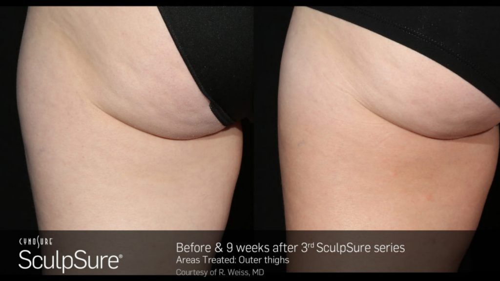 Before and after SculpSure results for butt