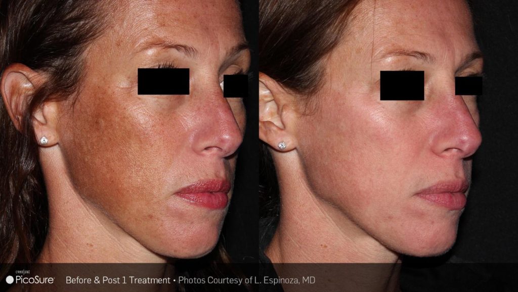 Before and after PicoSure results