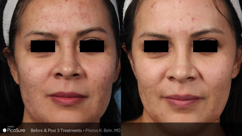 PicoSure before and after results