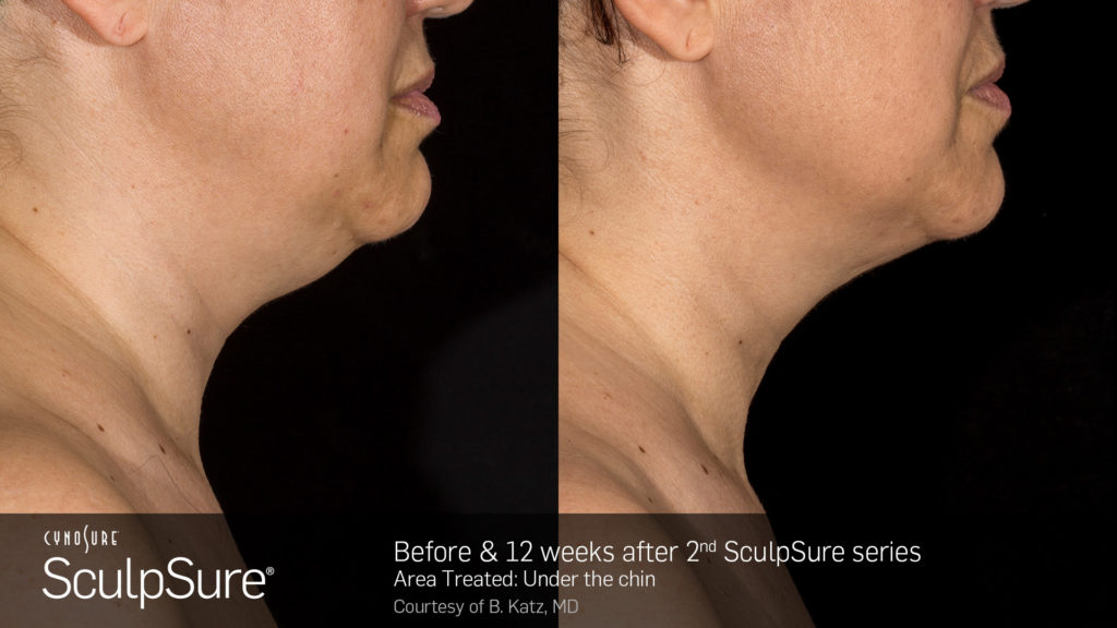 Before and after SculpSure submental results