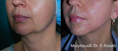 Before and after Morpheus8 results