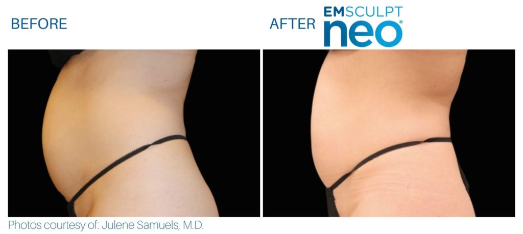 Before and after Emsculpt NEO® results