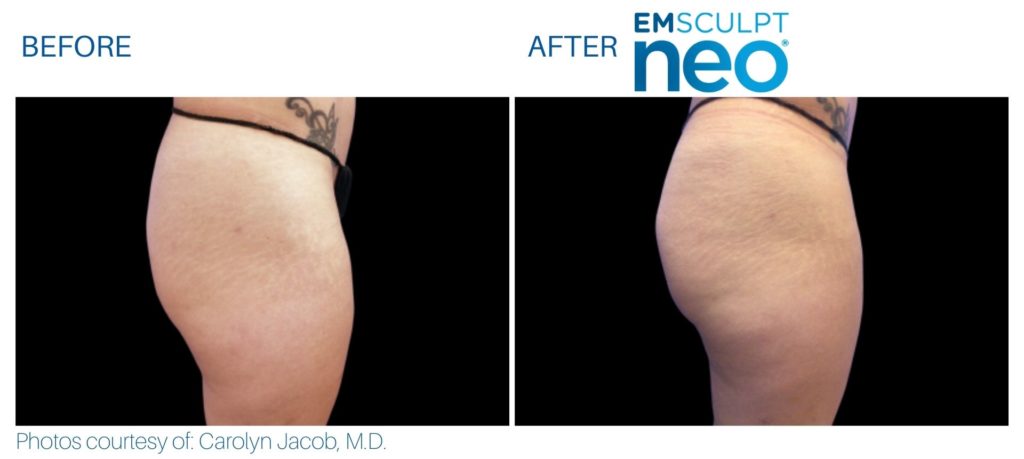 Before and after Emsculpt NEO® results