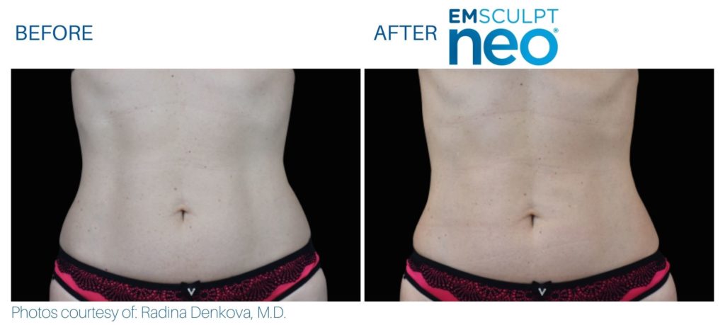 Before and after Emsculpt NEO® results