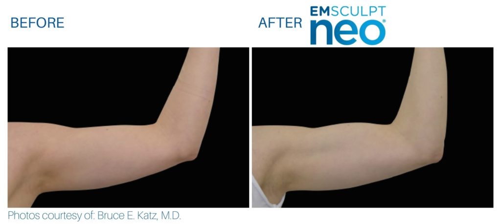 Before and after Emsculpt NEO® results