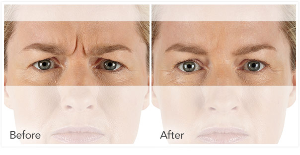 Before and after Xeomin results