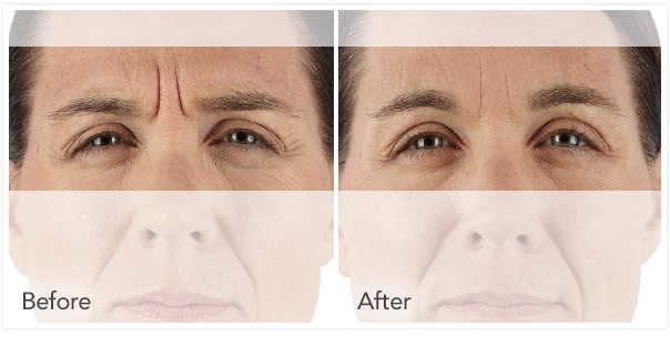 Before and after Xeomin results