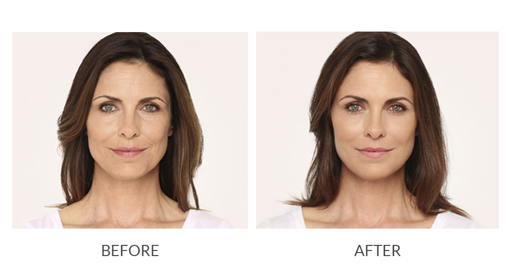 Before and after Radiesse results