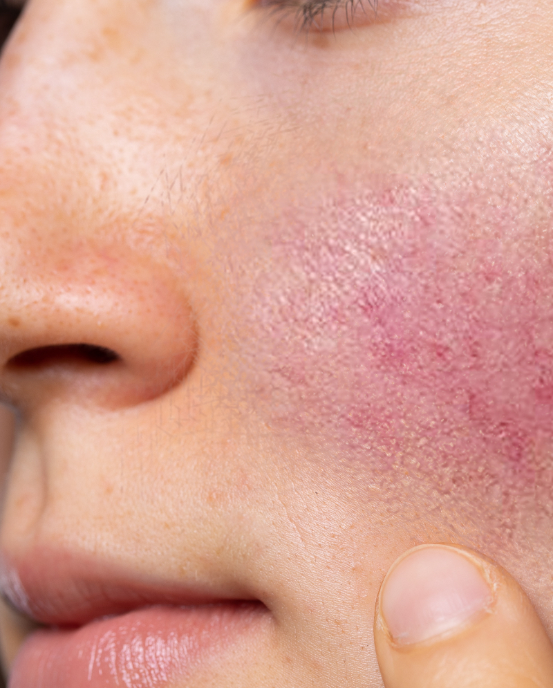 Rosacea