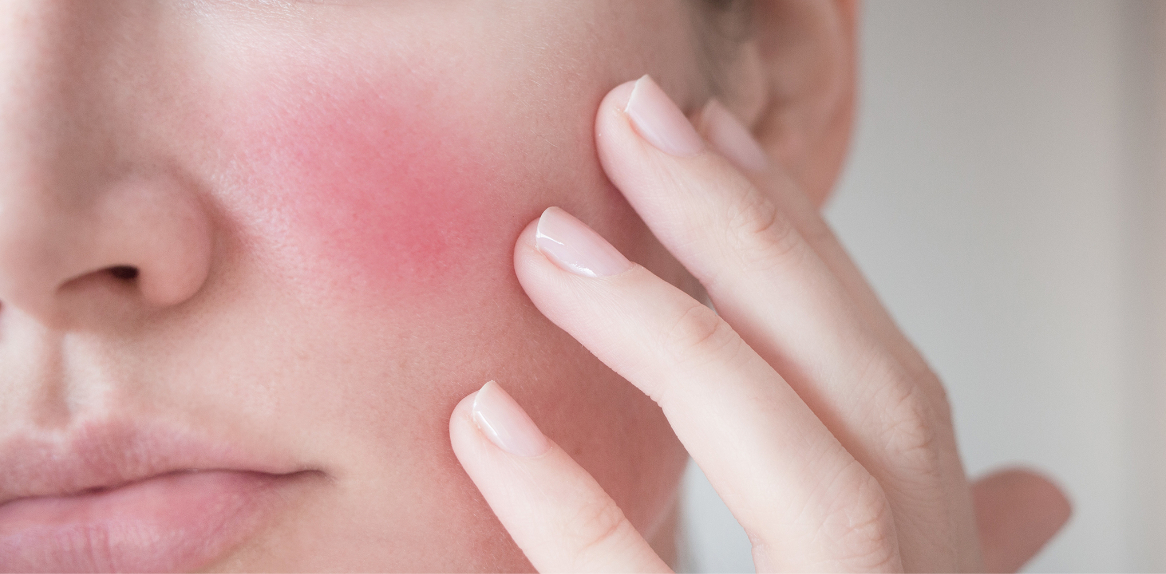 Rednessrosacea Treatments Sarasota Fl Marlowe Md