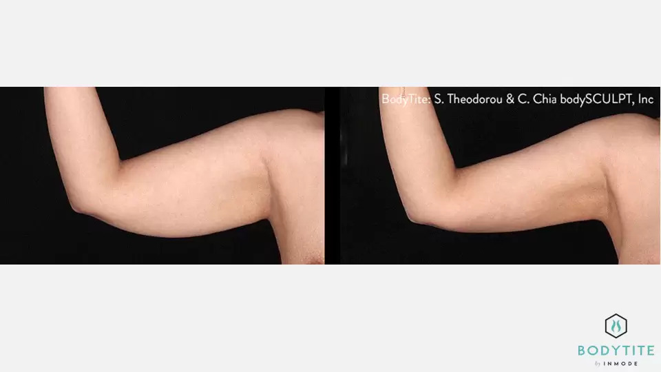 Before and after Bodytite results