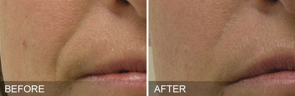 Before and after HydraFacial results