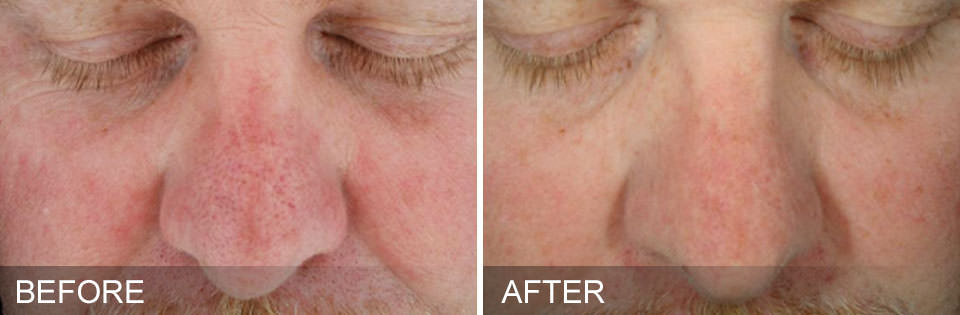 Before and after HydraFacial results