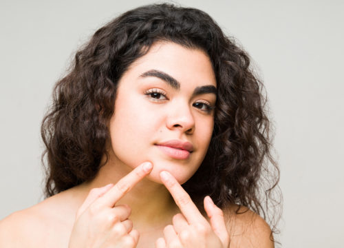 Woman with acne on her chin